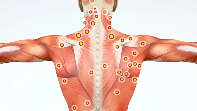 Trigger points marked across the upper back
